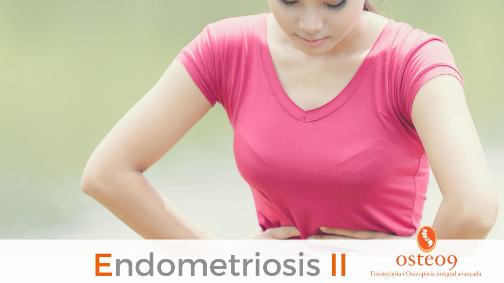 Endometriosis – Parte II