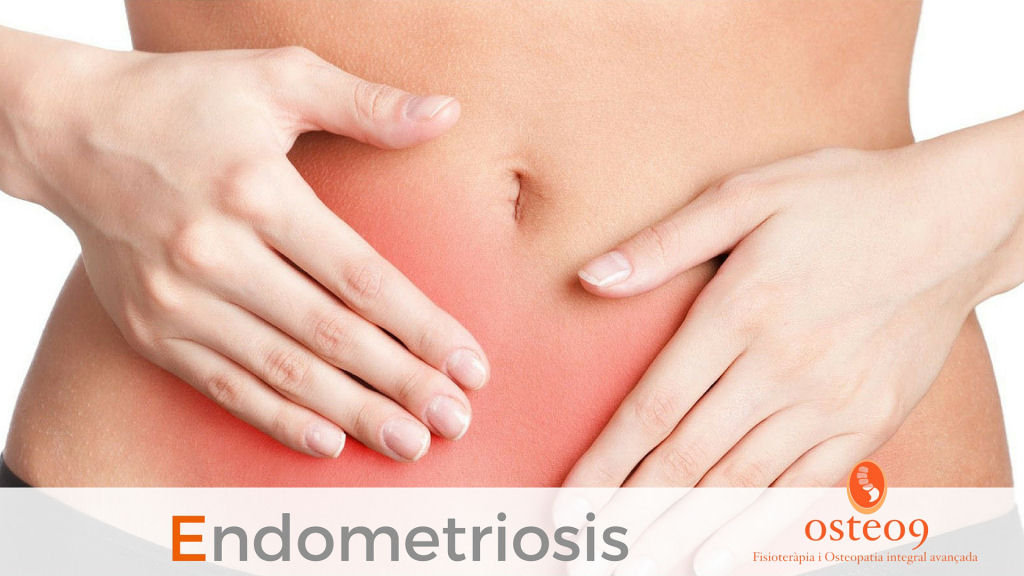 Endometriosis – Parte I
